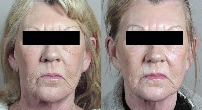 Halo™ Hybrid Fractional Case 304 Before & After View #2 | Paramus, New Jersey | Parker Center for Plastic Surgery