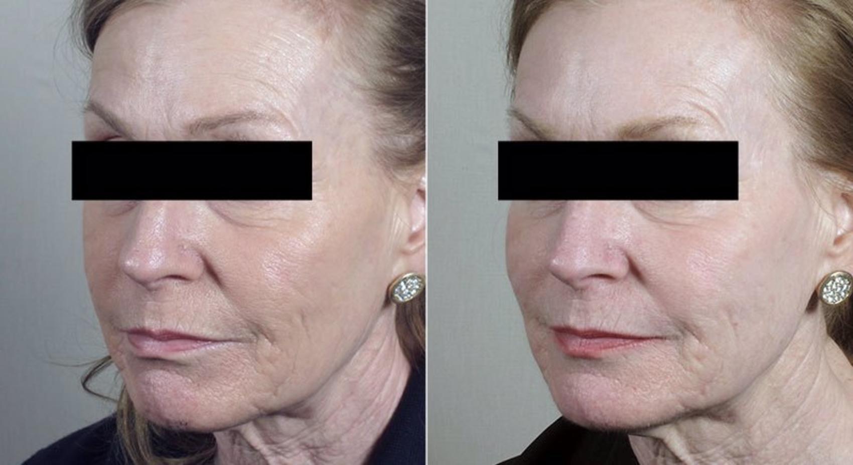 Halo™ Hybrid Fractional Case 305 Before & After View #1 | Paramus, New Jersey | Parker Center for Plastic Surgery