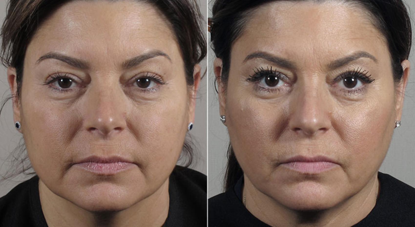 Halo™ Hybrid Fractional Case 306 Before & After View #1 | Paramus, New Jersey | Parker Center for Plastic Surgery
