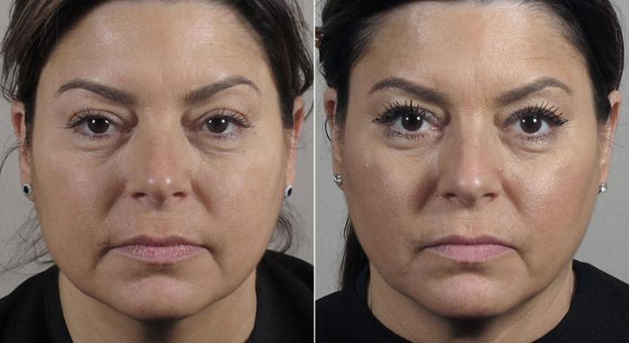 Halo™ Hybrid Fractional Case 306 Before & After View #1 | Paramus, New Jersey | Parker Center for Plastic Surgery