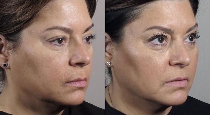 Halo™ Hybrid Fractional Case 306 Before & After View #2 | Paramus, New Jersey | Parker Center for Plastic Surgery