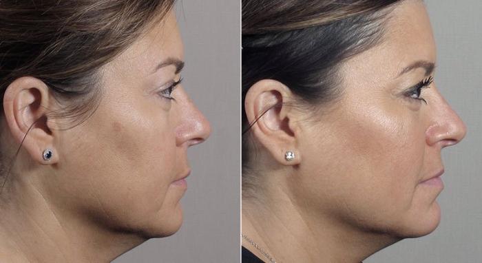 Halo™ Hybrid Fractional Case 306 Before & After View #3 | Paramus, New Jersey | Parker Center for Plastic Surgery