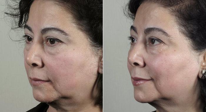 Halo™ Hybrid Fractional Case 308 Before & After View #2 | Paramus, New Jersey | Parker Center for Plastic Surgery