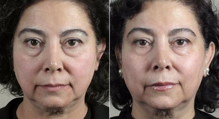 Halo™ Hybrid Fractional Case 308 Before & After View #3 | Paramus, New Jersey | Parker Center for Plastic Surgery