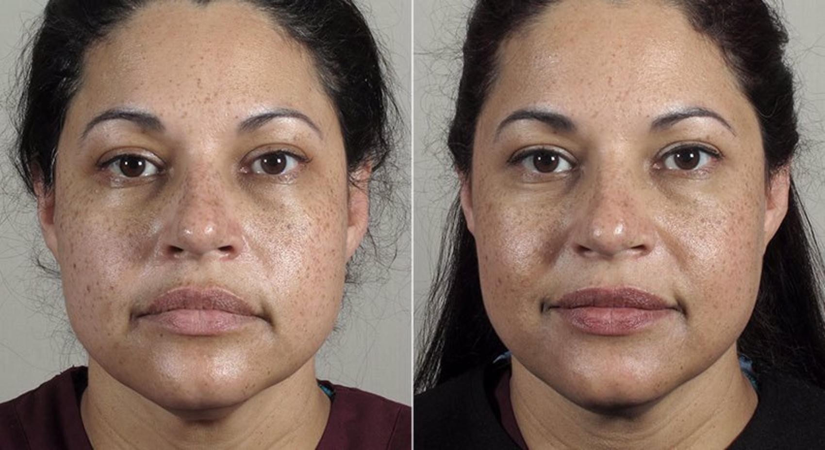 Halo™ Hybrid Fractional Case 309 Before & After View #1 | Paramus, New Jersey | Parker Center for Plastic Surgery