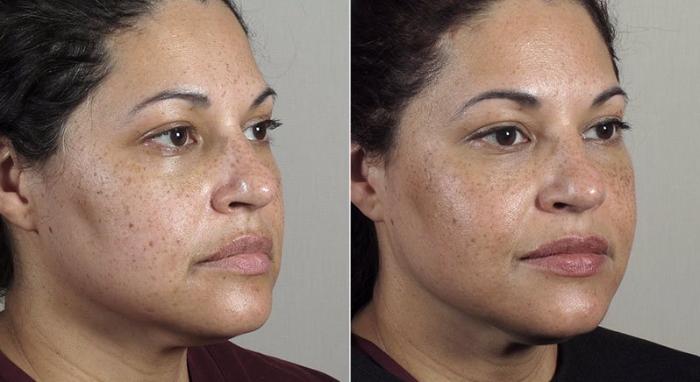 Halo™ Hybrid Fractional Case 309 Before & After View #2 | Paramus, New Jersey | Parker Center for Plastic Surgery