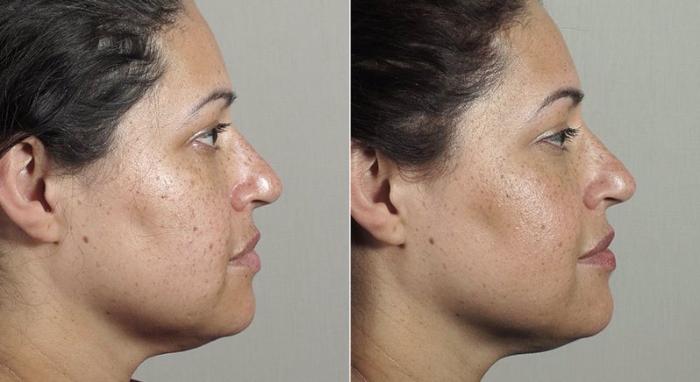 Halo™ Hybrid Fractional Case 309 Before & After View #3 | Paramus, New Jersey | Parker Center for Plastic Surgery