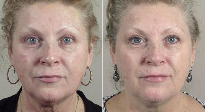 Halo™ Hybrid Fractional Case 310 Before & After View #1 | Paramus, New Jersey | Parker Center for Plastic Surgery