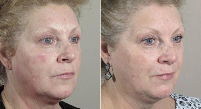 Halo™ Hybrid Fractional Case 310 Before & After View #2 | Paramus, New Jersey | Parker Center for Plastic Surgery
