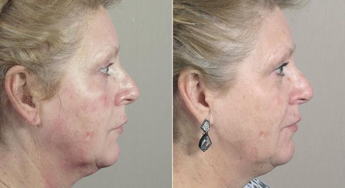 Halo™ Hybrid Fractional Case 310 Before & After View #3 | Paramus, New Jersey | Parker Center for Plastic Surgery