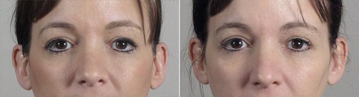 Halo™ Hybrid Fractional Case 314 Before & After View #1 | Paramus, New Jersey | Parker Center for Plastic Surgery
