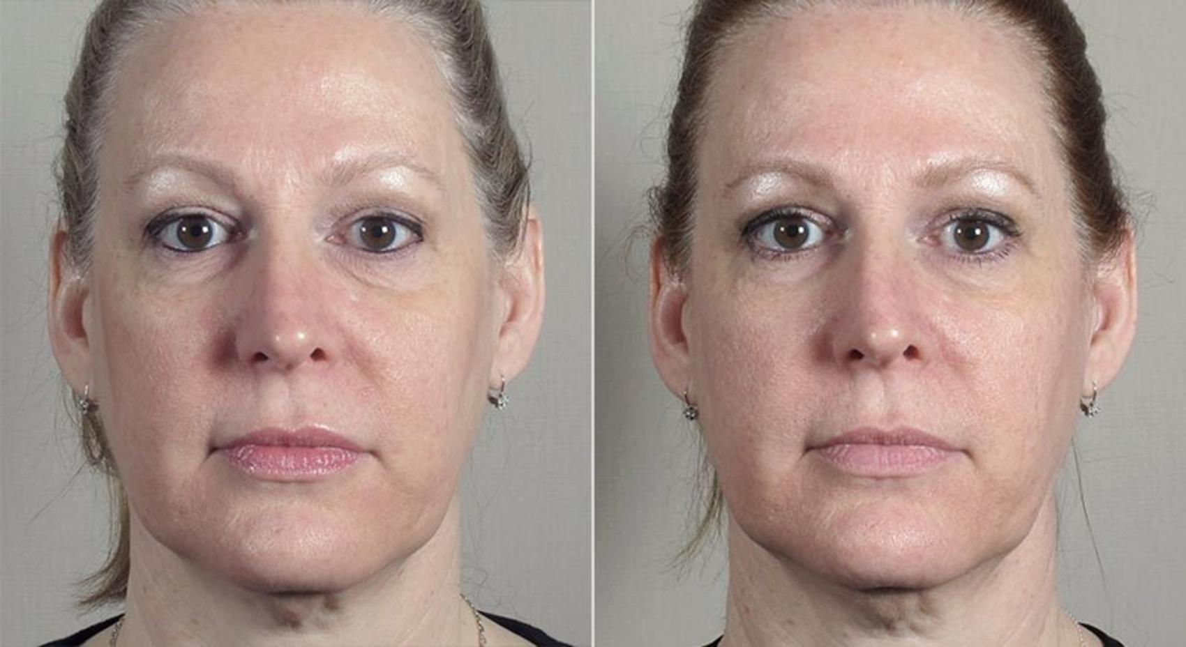 Halo™ Hybrid Fractional Case 315 Before & After View #1 | Paramus, New Jersey | Parker Center for Plastic Surgery