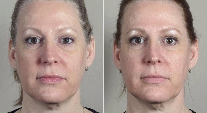 Halo™ Hybrid Fractional Case 315 Before & After View #1 | Paramus, New Jersey | Parker Center for Plastic Surgery