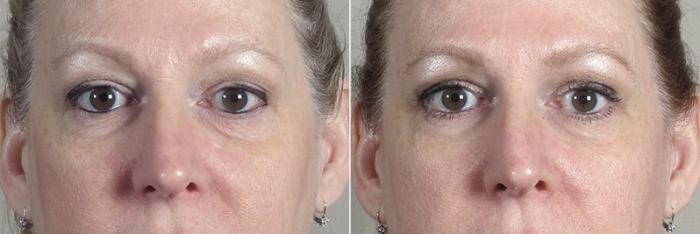 Halo™ Hybrid Fractional Case 315 Before & After View #2 | Paramus, New Jersey | Parker Center for Plastic Surgery