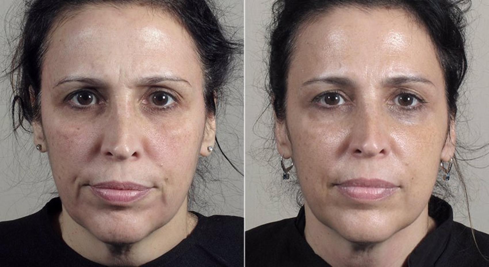 Halo™ Hybrid Fractional Case 316 Before & After View #1 | Paramus, New Jersey | Parker Center for Plastic Surgery