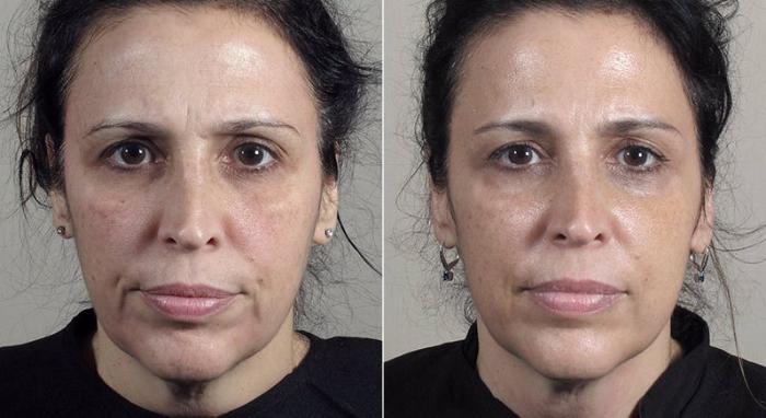 Halo™ Hybrid Fractional Case 316 Before & After View #1 | Paramus, New Jersey | Parker Center for Plastic Surgery