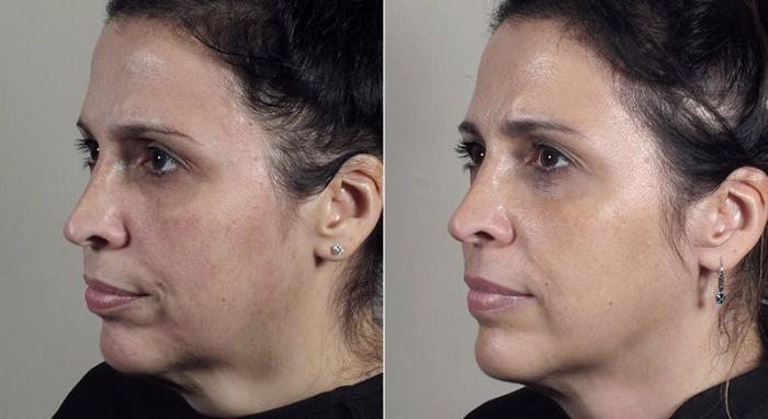 Halo™ Hybrid Fractional Case 316 Before & After View #2 | Paramus, New Jersey | Parker Center for Plastic Surgery