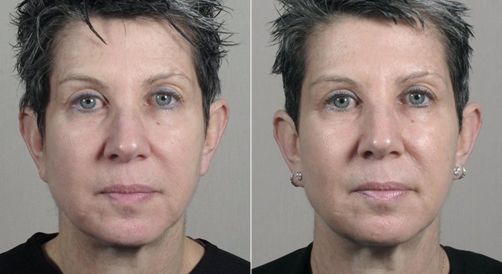 Halo™ Hybrid Fractional Case 317 Before & After View #1 | Paramus, New Jersey | Parker Center for Plastic Surgery