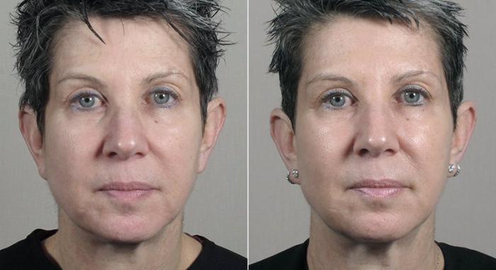 Halo™ Hybrid Fractional Case 317 Before & After View #1 | Paramus, New Jersey | Parker Center for Plastic Surgery