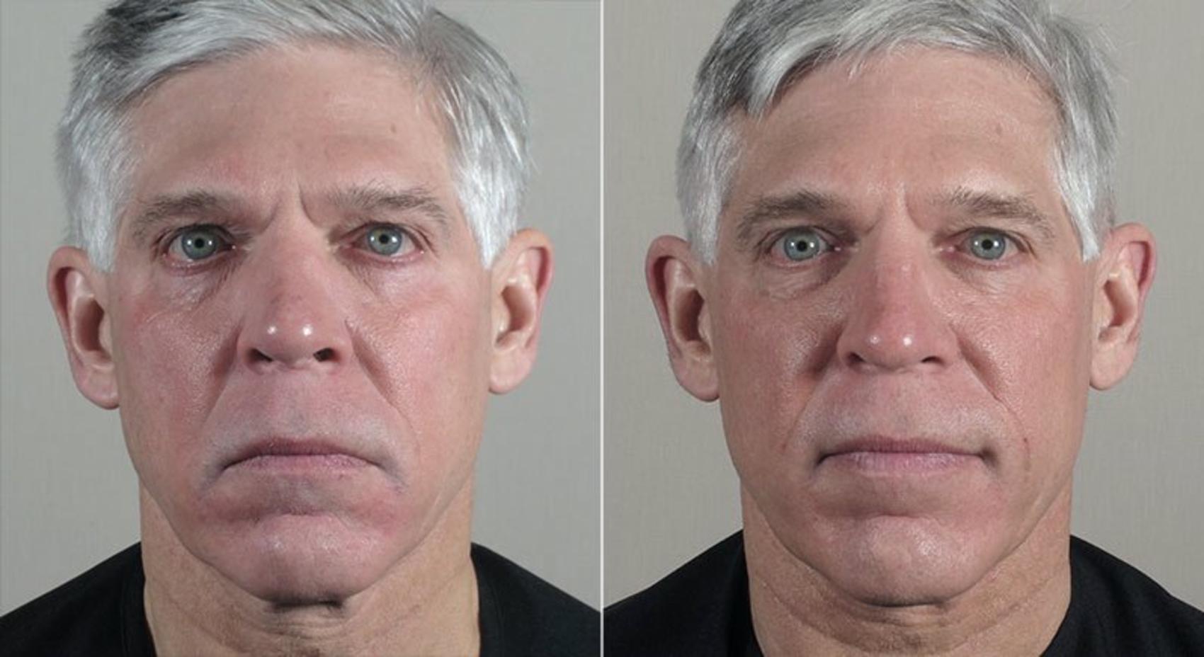 Halo™ Hybrid Fractional Case 318 Before & After View #1 | Paramus, New Jersey | Parker Center for Plastic Surgery