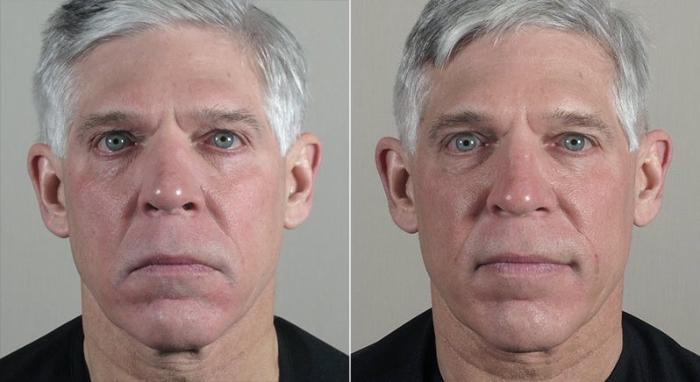 Halo™ Hybrid Fractional Case 318 Before & After View #1 | Paramus, New Jersey | Parker Center for Plastic Surgery