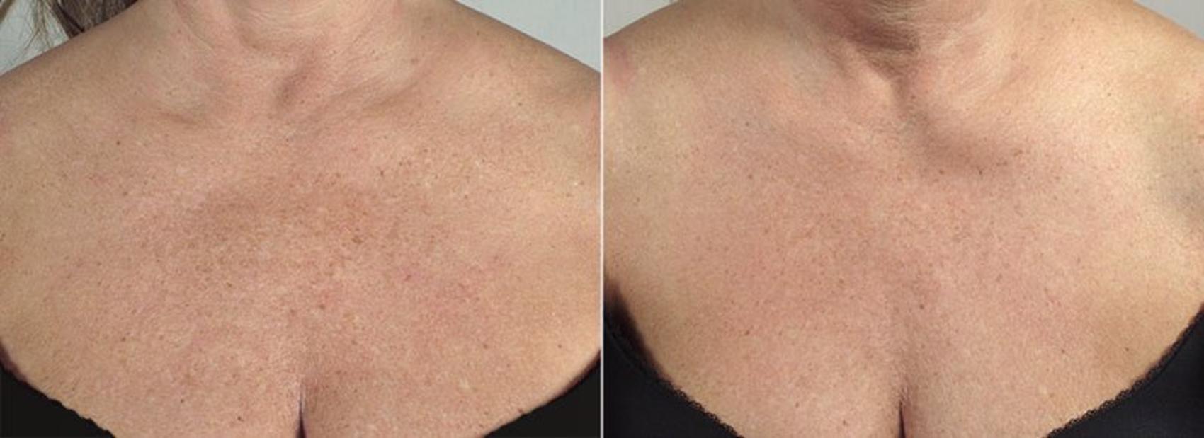 Halo™ Hybrid Fractional Case 321 Before & After View #1 | Paramus, New Jersey | Parker Center for Plastic Surgery