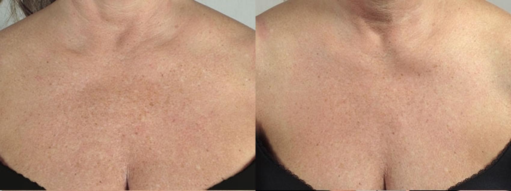 Halo™ Hybrid Fractional Case 961 Before & After View #5 | Paramus, New Jersey | Parker Center for Plastic Surgery