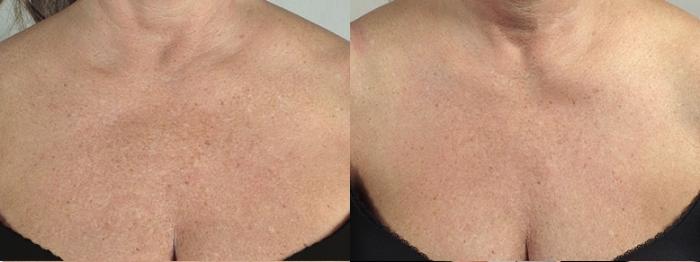 Halo™ Hybrid Fractional Case 961 Before & After View #5 | Paramus, New Jersey | Parker Center for Plastic Surgery