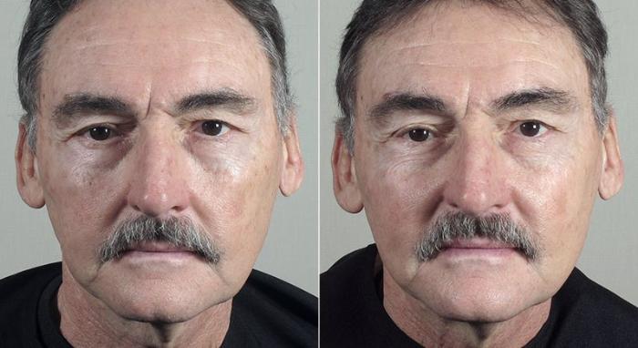 Halo™ Laser & Forever Young BBL™ Case 320 Before & After View #2 | Paramus, New Jersey | Parker Center for Plastic Surgery