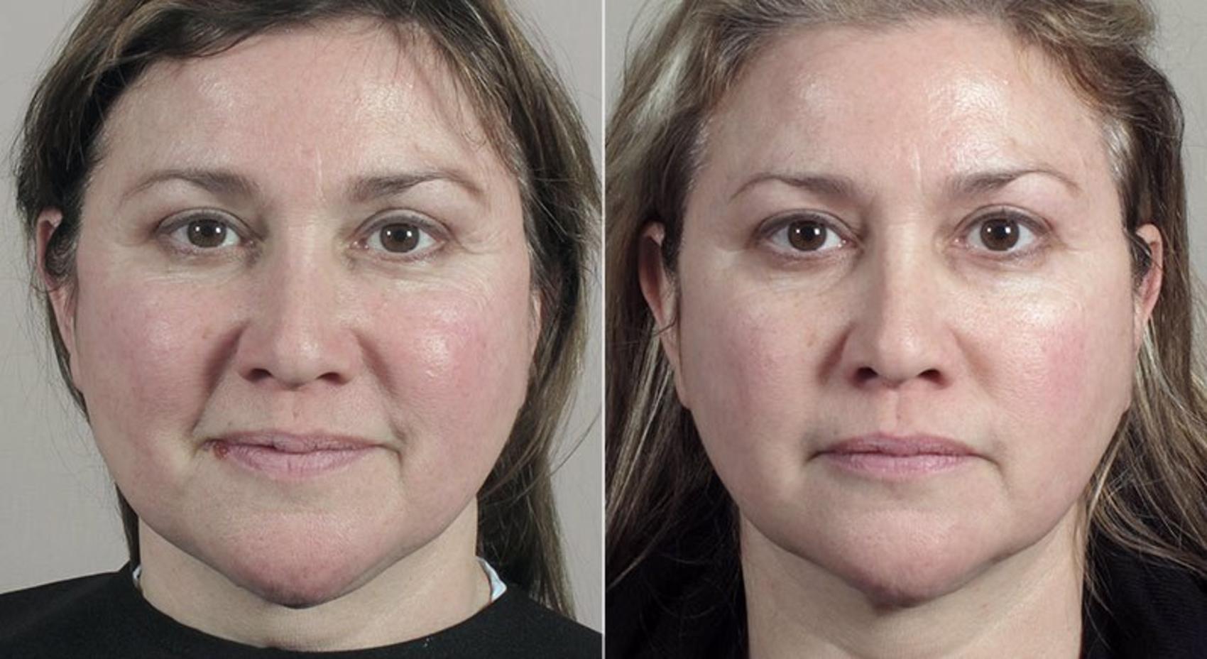 Halo™ Laser & Forever Young BBL™ Case 324 Before & After View #1 | Paramus, New Jersey | Parker Center for Plastic Surgery