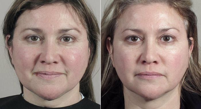 Halo™ Laser & Forever Young BBL™ Case 324 Before & After View #1 | Paramus, New Jersey | Parker Center for Plastic Surgery