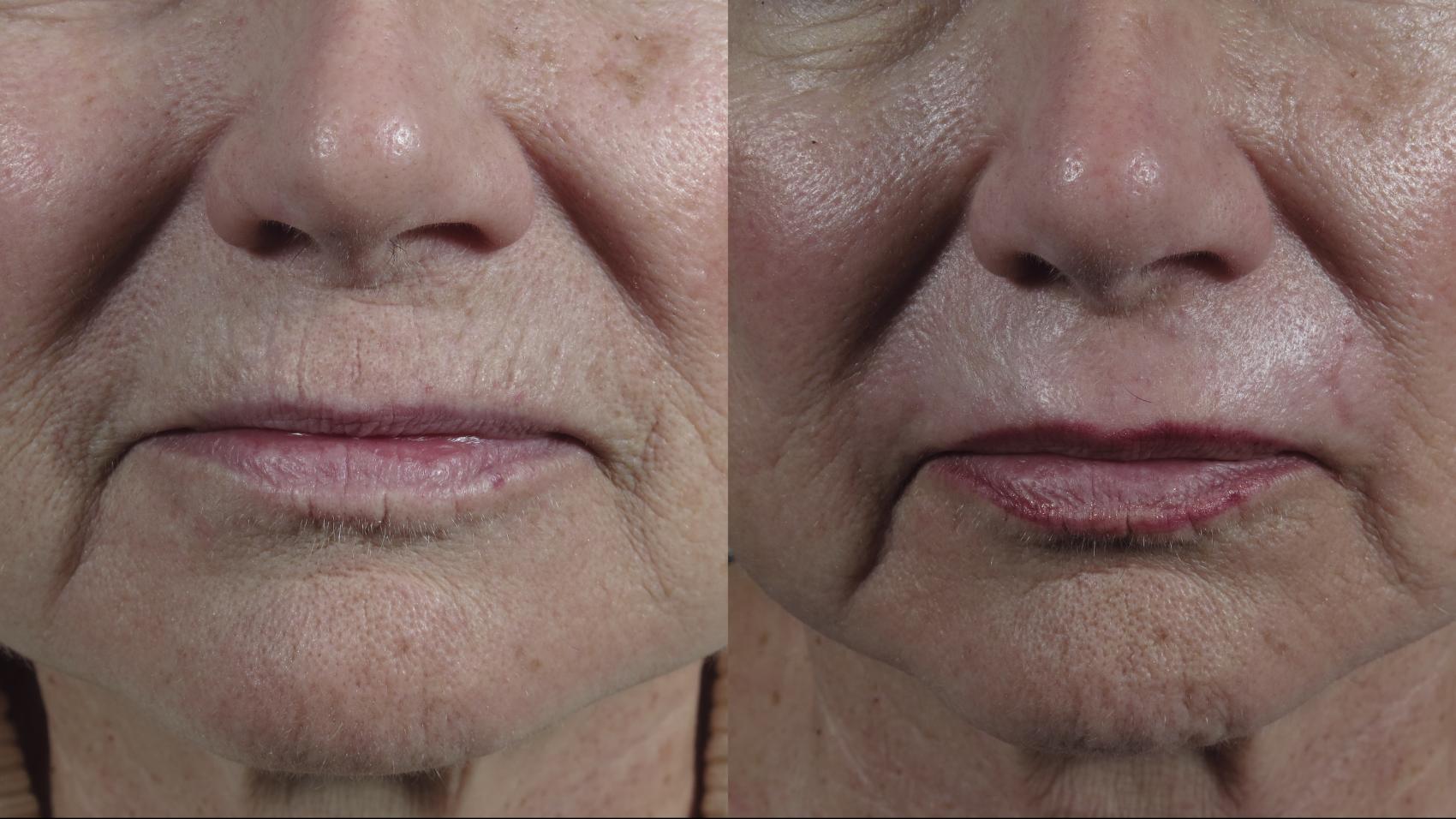Lip Enhancement Case 1013 Before & After Close up lips | Paramus, New Jersey | Parker Center for Plastic Surgery