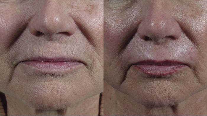 Lip Enhancement Case 1013 Before & After Close up lips | Paramus, New Jersey | Parker Center for Plastic Surgery