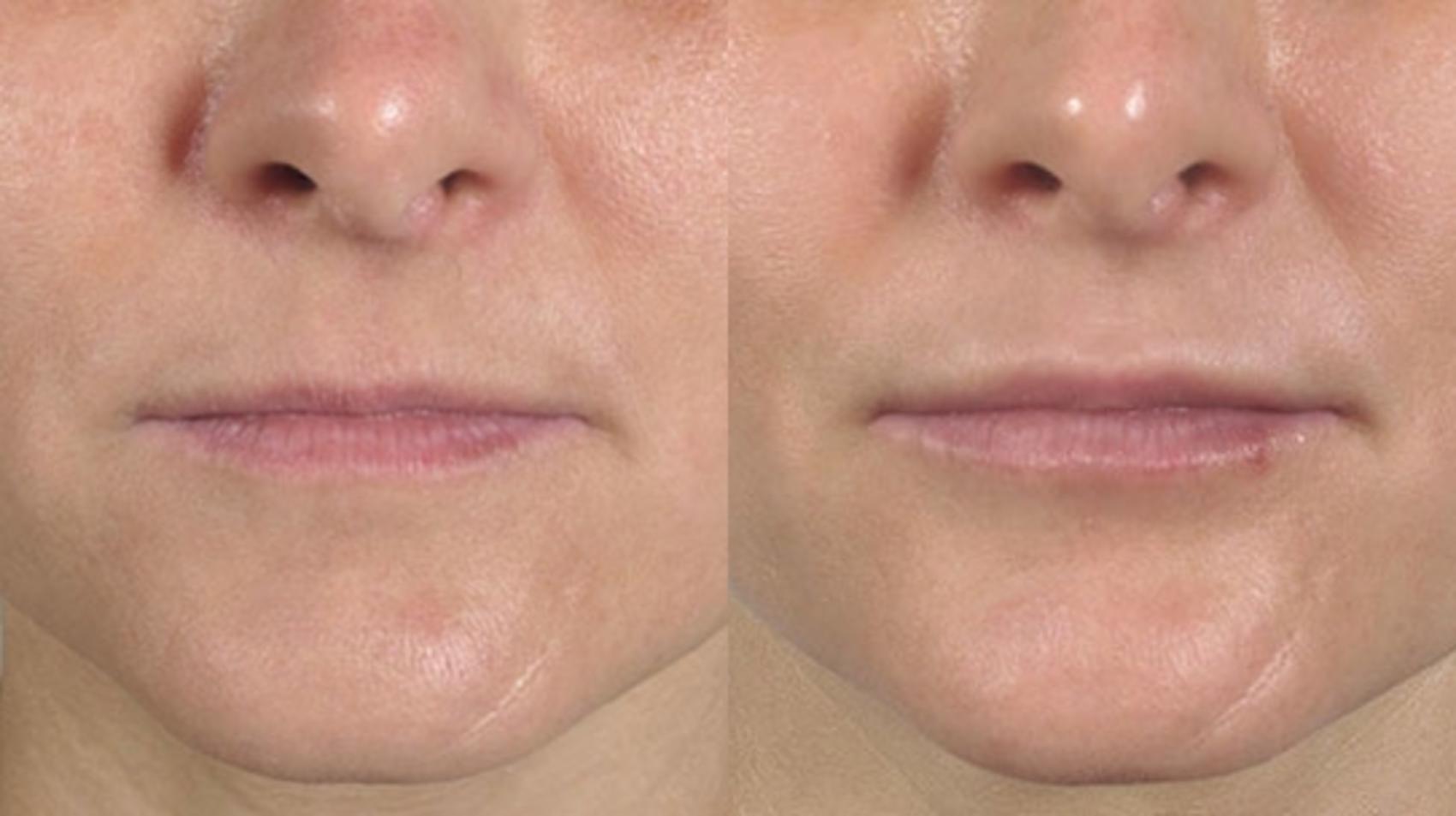 Lip Enhancement Case 257 Before & After View #1 | Paramus, New Jersey | Parker Center for Plastic Surgery