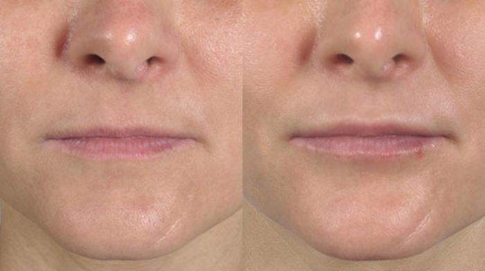 Lip Enhancement Case 257 Before & After View #1 | Paramus, New Jersey | Parker Center for Plastic Surgery
