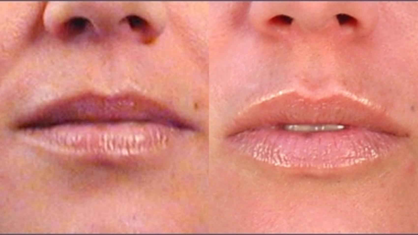 Lip Enhancement Case 259 Before & After View #1 | Paramus, New Jersey | Parker Center for Plastic Surgery