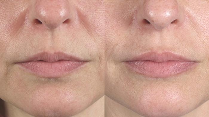 Lip Enhancement Case 263 Before & After View #1 | Paramus, New Jersey | Parker Center for Plastic Surgery