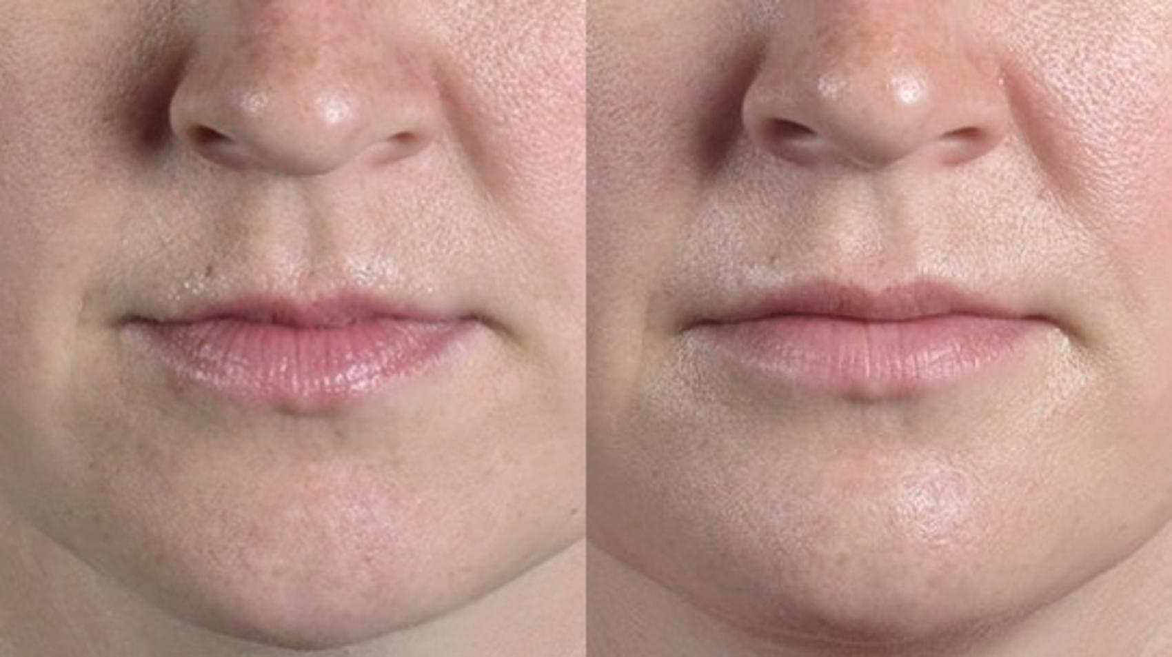 Lip Enhancement Case 264 Before & After View #1 | Paramus, New Jersey | Parker Center for Plastic Surgery