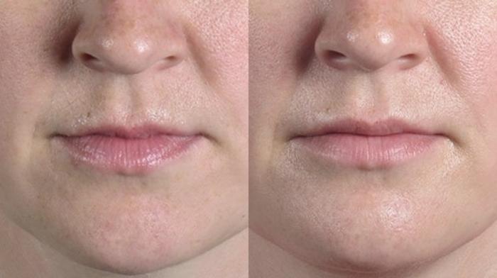 Lip Enhancement Case 264 Before & After View #1 | Paramus, New Jersey | Parker Center for Plastic Surgery