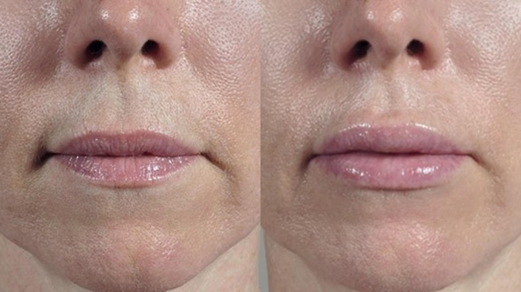 Lip Enhancement Case 265 Before & After View #1 | Paramus, New Jersey | Parker Center for Plastic Surgery
