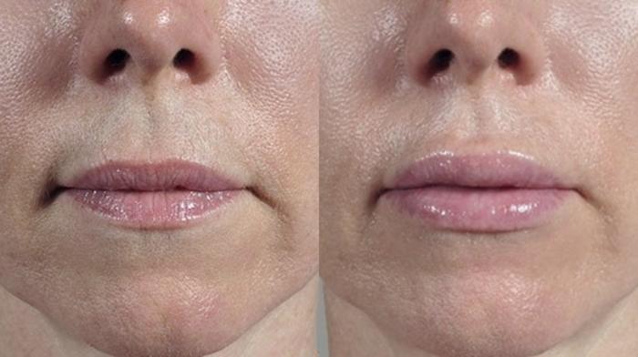 Lip Enhancement Case 265 Before & After View #1 | Paramus, New Jersey | Parker Center for Plastic Surgery