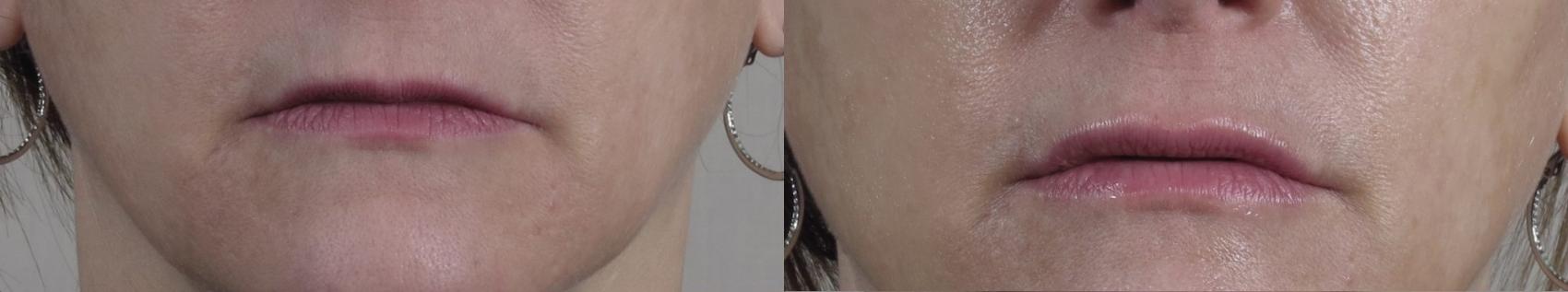 Lip Enhancement Case 963 Before & After View #5 | Paramus, New Jersey | Parker Center for Plastic Surgery
