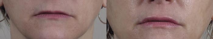 Lip Enhancement Case 963 Before & After View #5 | Paramus, New Jersey | Parker Center for Plastic Surgery