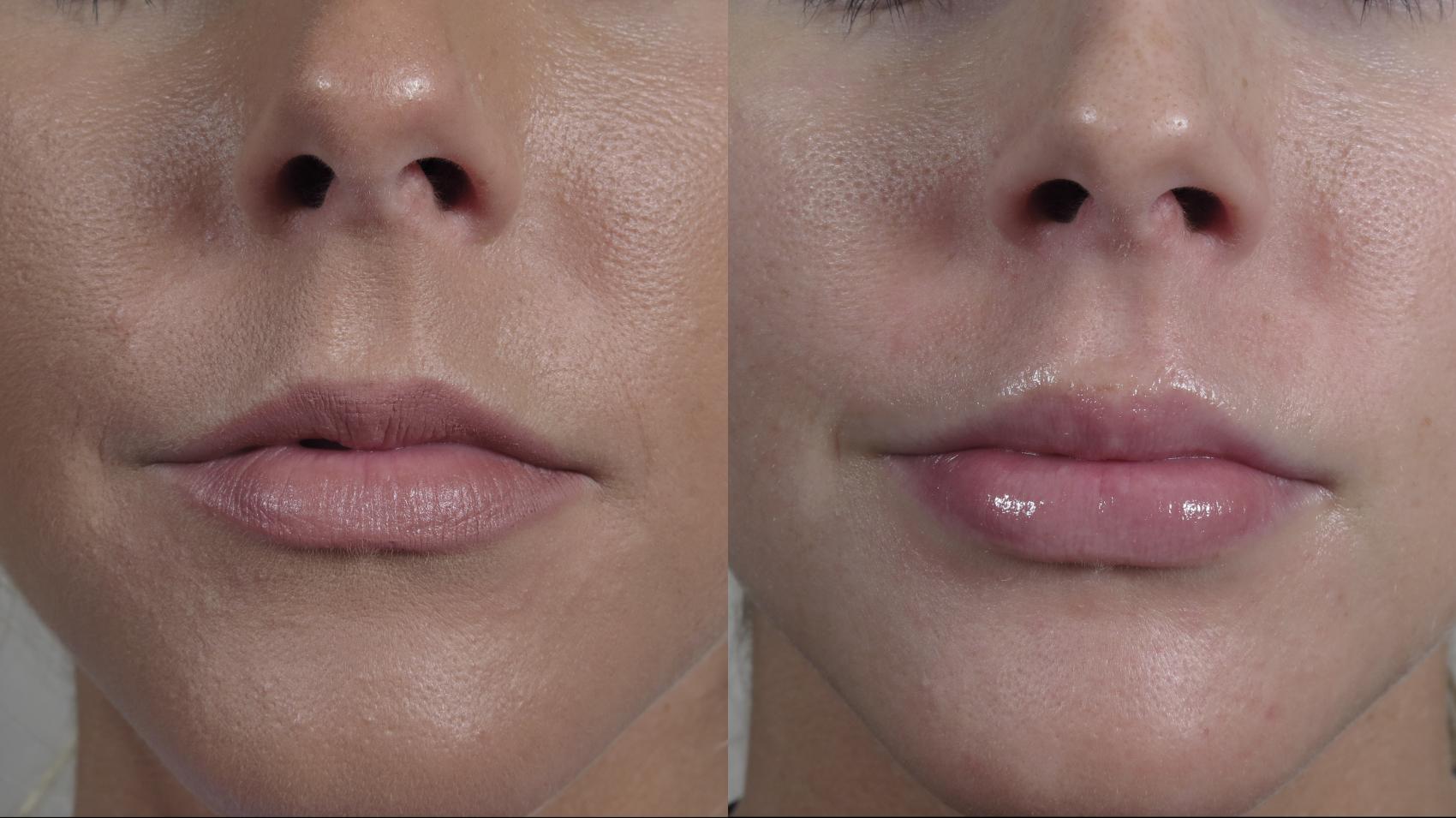 Lip Enhancement Case 979 Before & After Front | Paramus, New Jersey | Parker Center for Plastic Surgery
