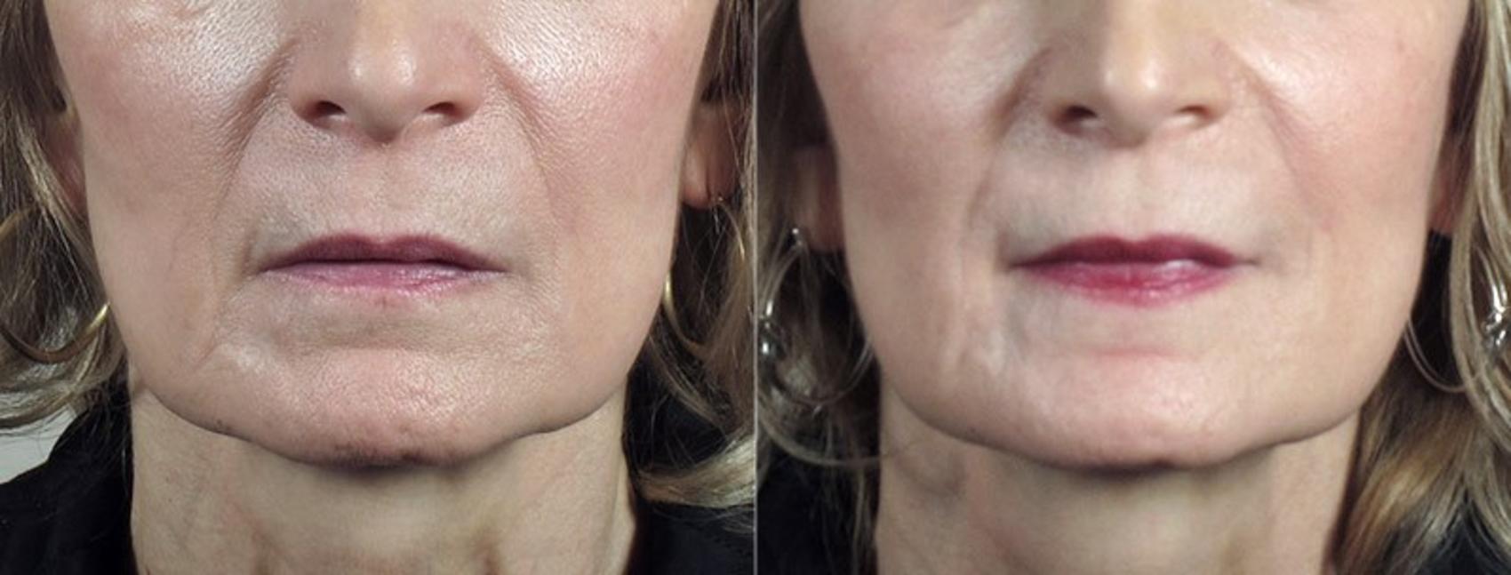 Nonsurgical Face Procedures Case 298 Before & After View #1 | Paramus, New Jersey | Parker Center for Plastic Surgery