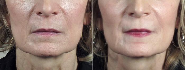 Lip Injections Case 298 Before & After View #1 | Paramus, New Jersey | Parker Center for Plastic Surgery