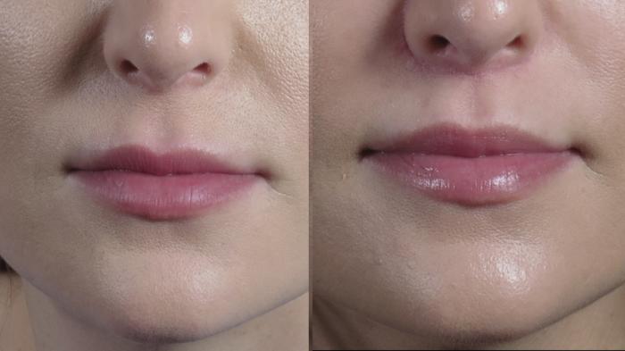 Lip Lift Case 1290 Before & After Front | Paramus, New Jersey | Parker Center for Plastic Surgery