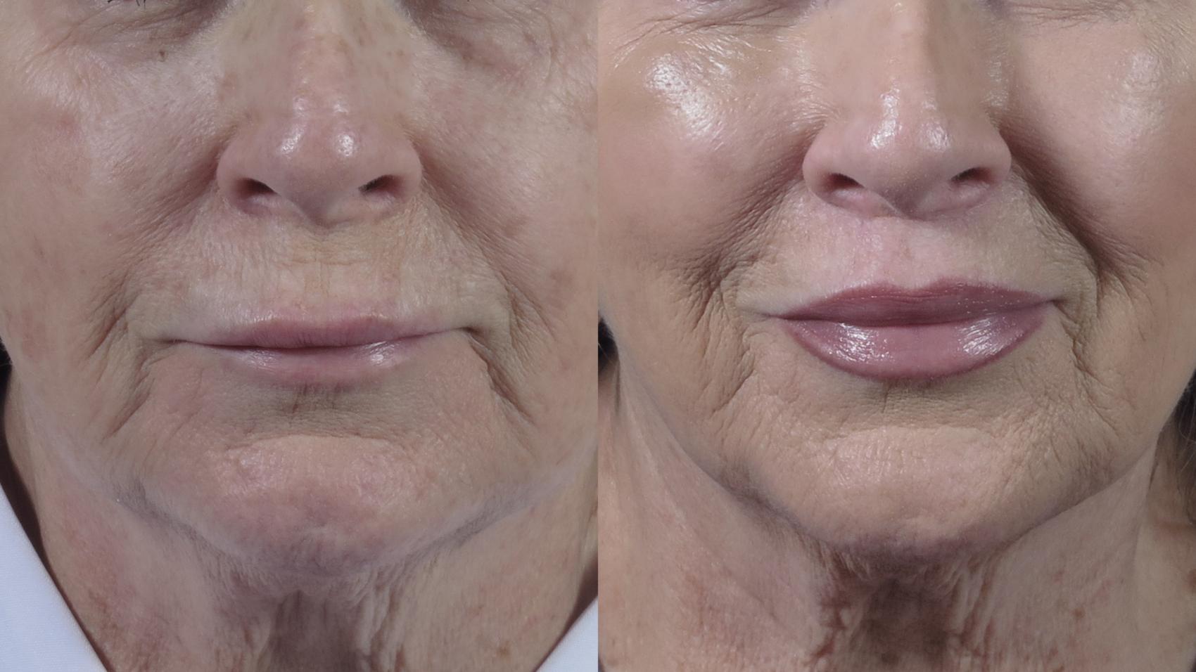 Lip Lift Case 1355 Before & After Front | Paramus, New Jersey | Parker Center for Plastic Surgery