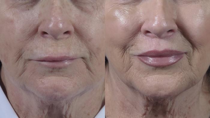 Lip Lift Case 1355 Before & After Front | Paramus, New Jersey | Parker Center for Plastic Surgery