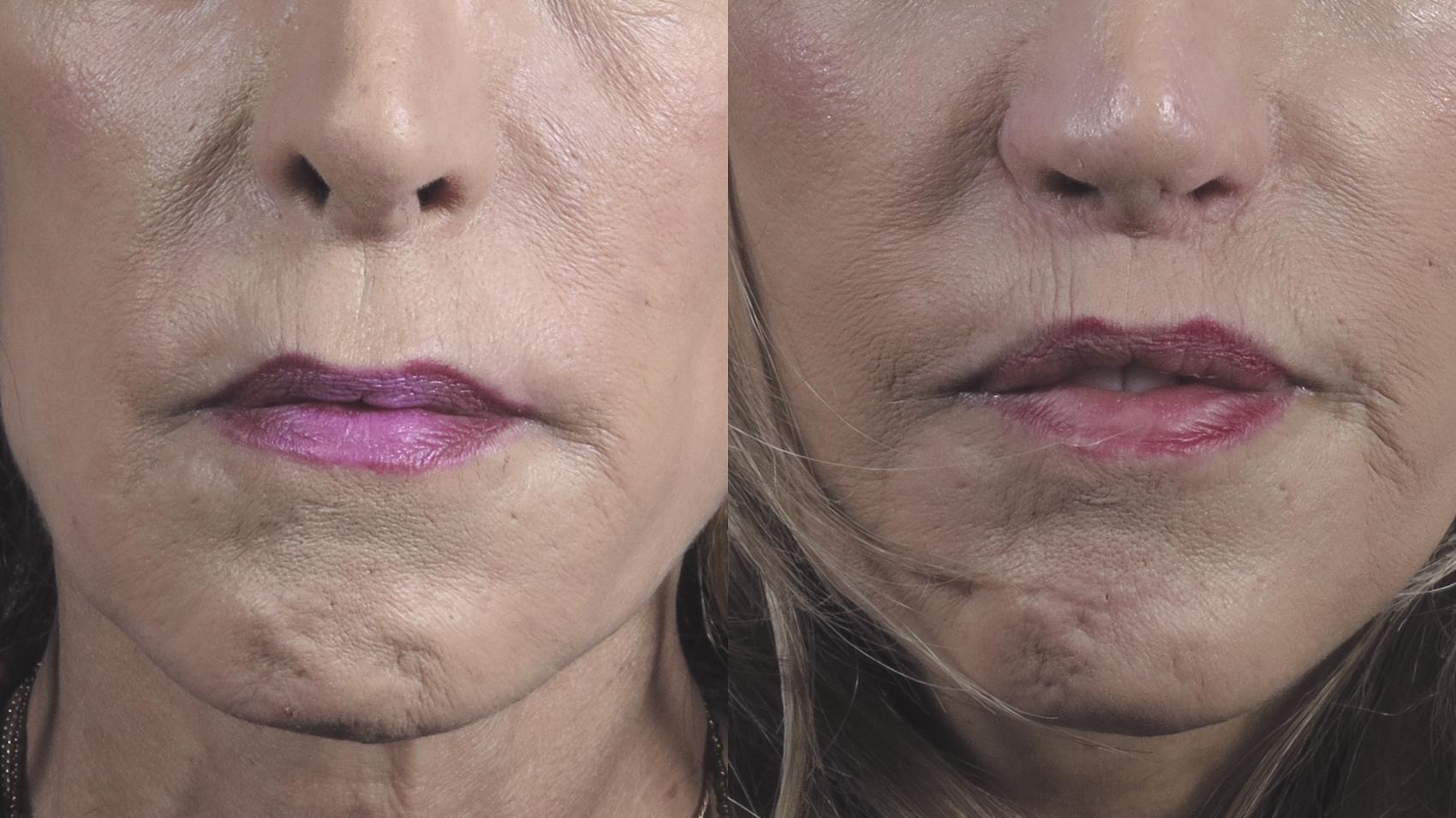 Lip Lift Case 1376 Before & After Front | Paramus, New Jersey | Parker Center for Plastic Surgery